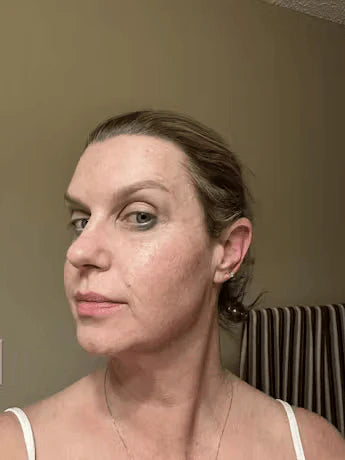 Customer skin result photo